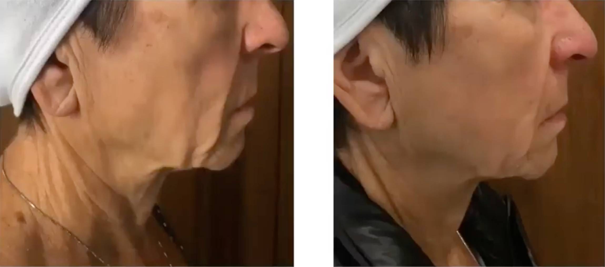 Pro Vorher Nacher1 Vorher Nachher Dermatologie Hanau